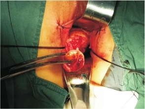 数字报-子宫动脉下行支阻断 br 在宫颈锥切术中