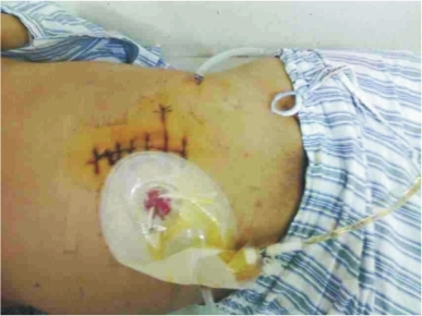 盛京周刊数字报-第二泌尿外科病房成功完成 b